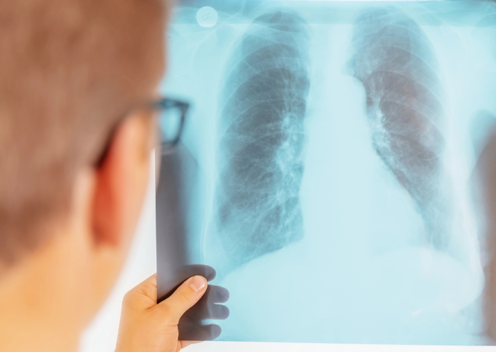 Tuberculosis Prevention Through Hopkins County Health Dept